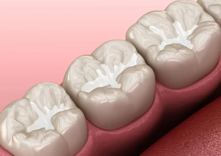 Illustration of dental sealants filling the grooves of back molars