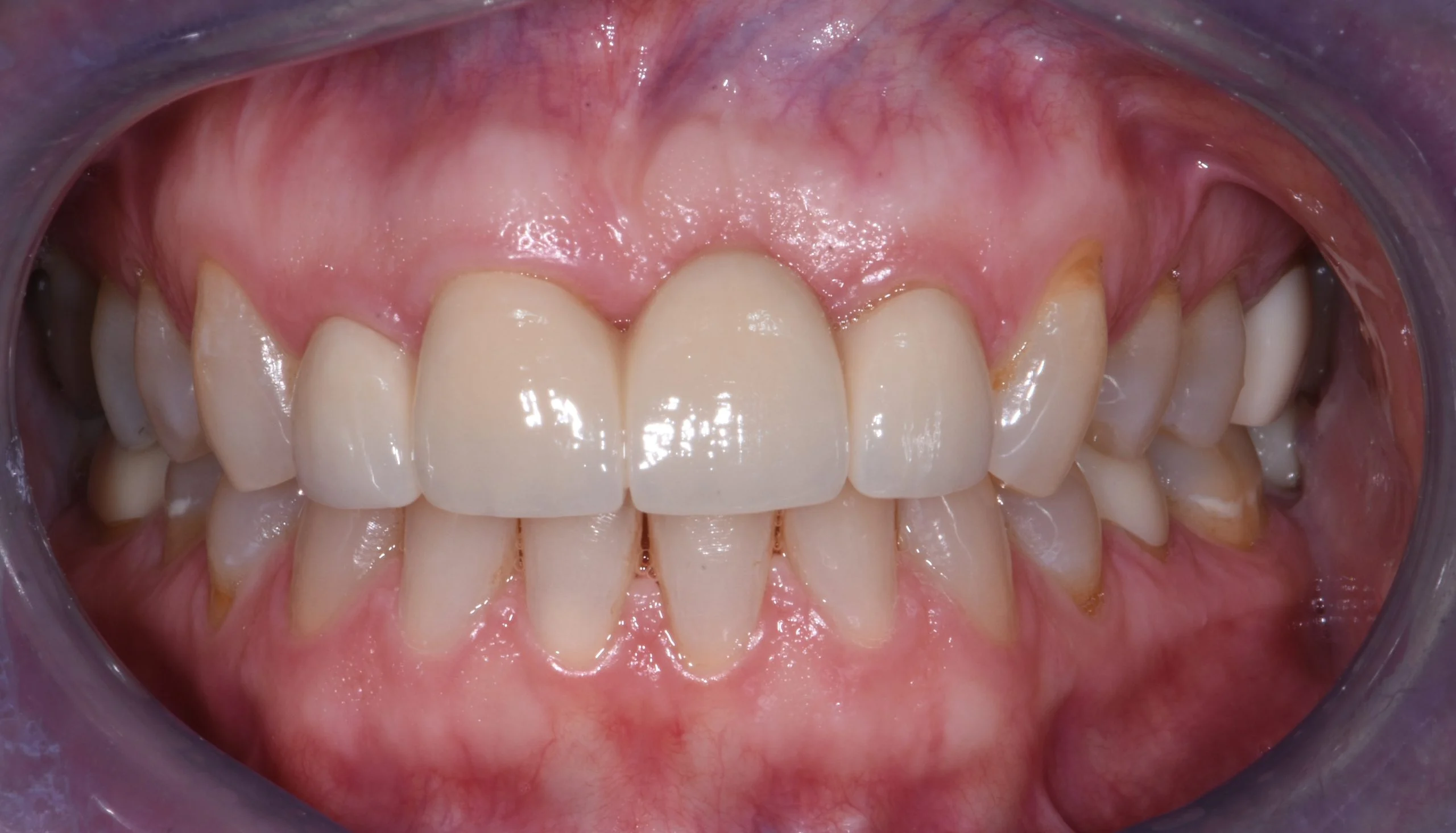Smile gallery case 1, after treatment: straight, even upper front teeth with healthy gums