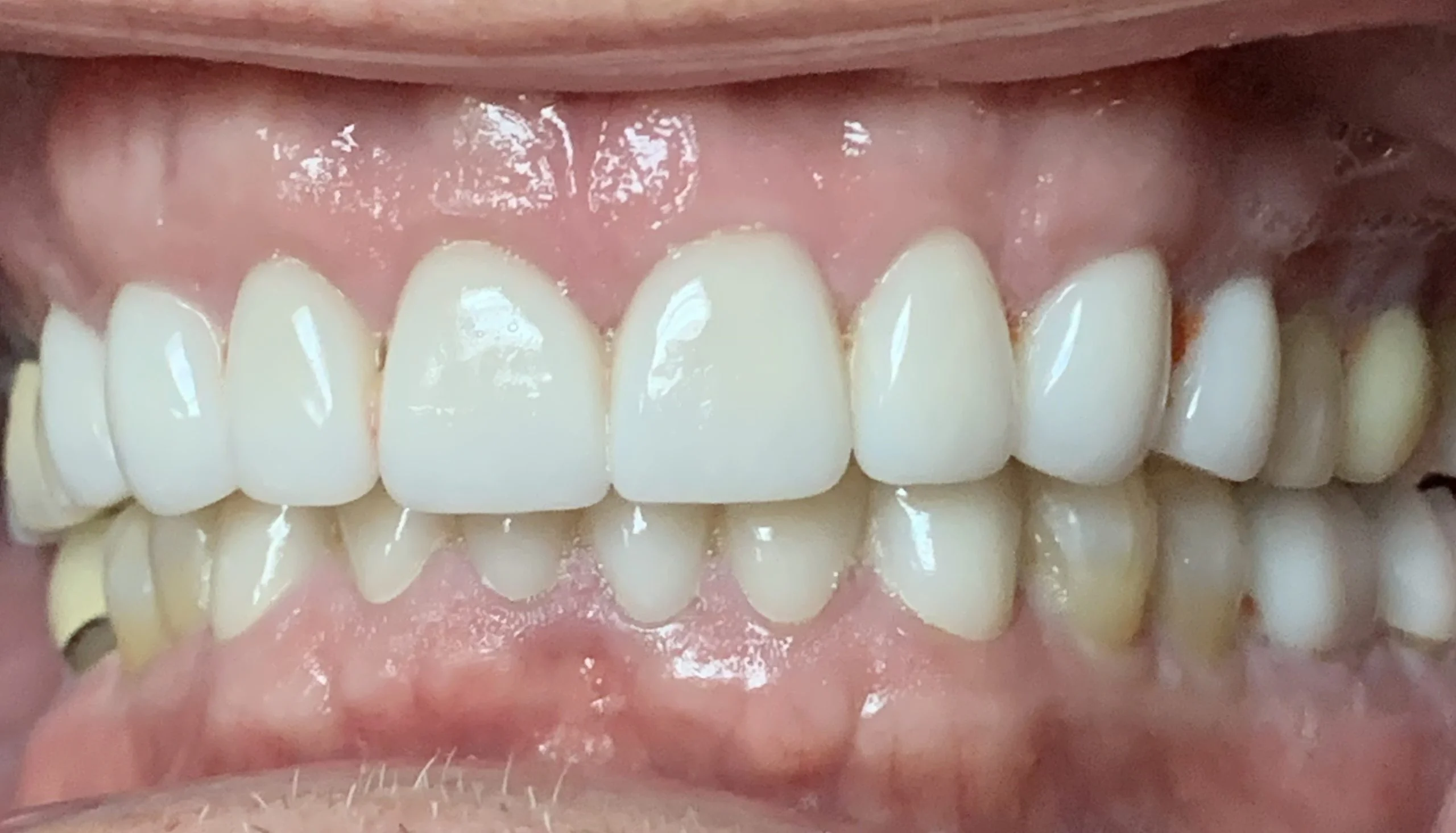 Smile gallery case 2, after treatment: bright, evenly shaped upper and lower teeth