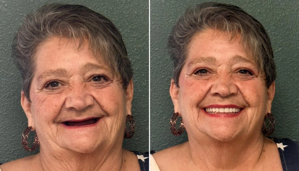 Before and after smile treatment: woman with missing front teeth now smiling with a full set of teeth