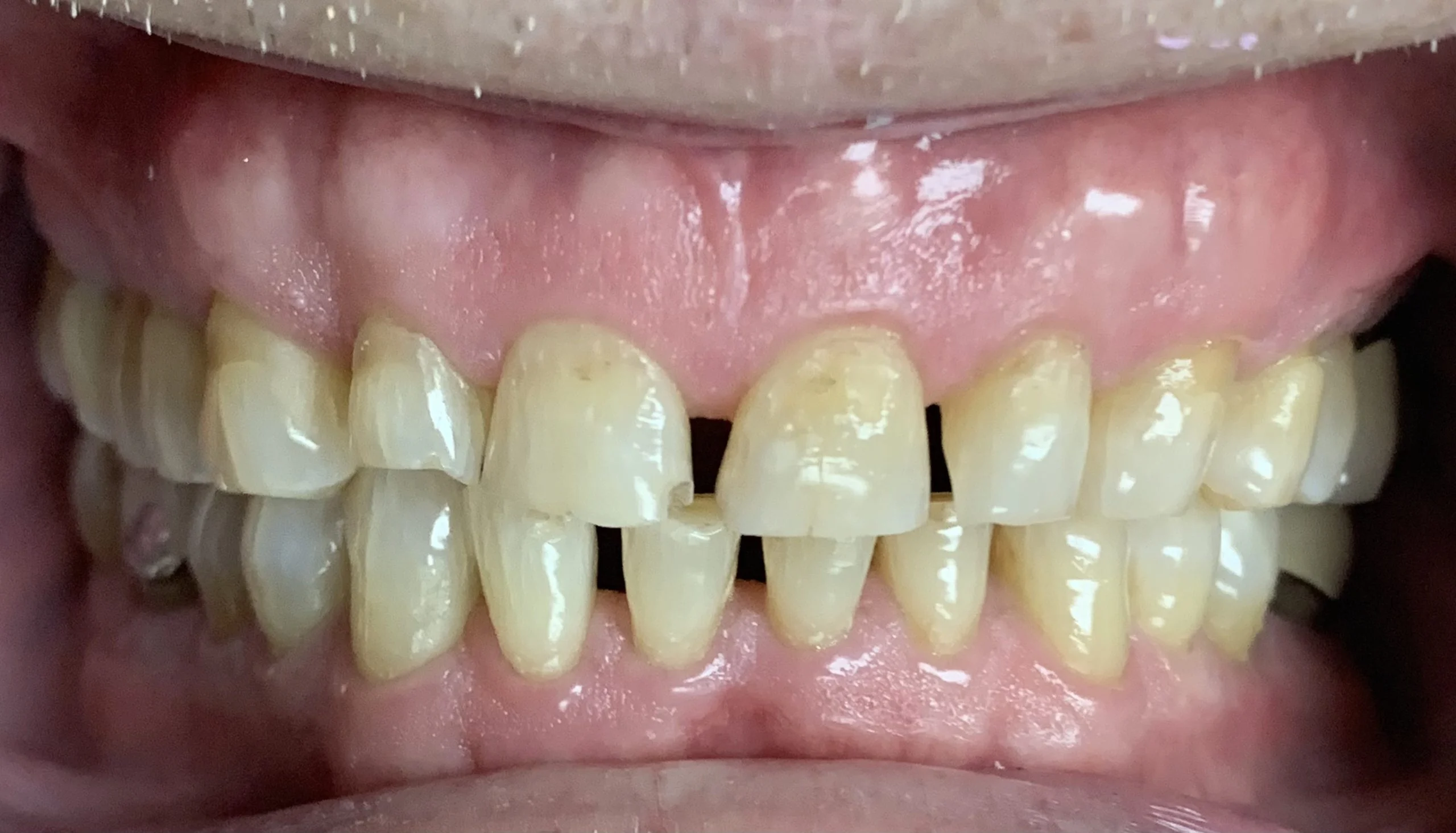 Smile gallery case 2, before treatment: worn, yellowed teeth with gaps between the upper front teeth